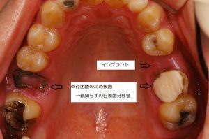 症例紹介 自家歯牙移植 インプラント あおぞら歯科クリニック 高崎市